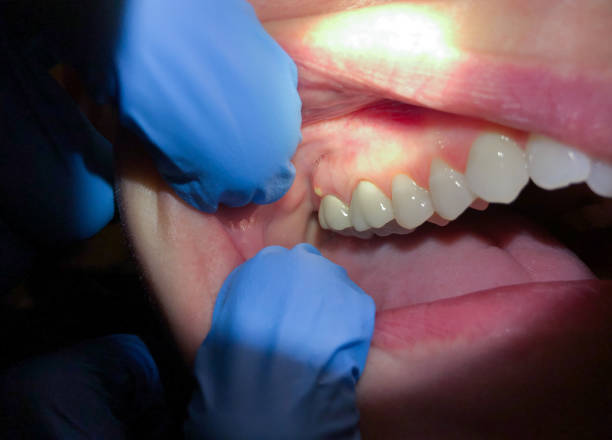 Best Knocked-Out Tooth (Avulsed Tooth) Treatment in Uhland, TX